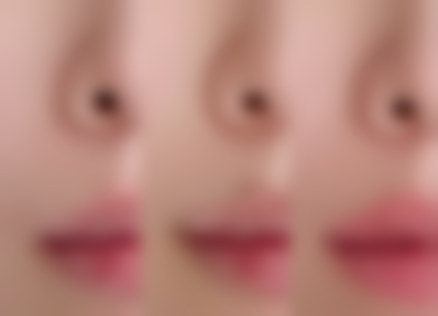 五、上海大麦微针植发栾星微医生技术怎么样?