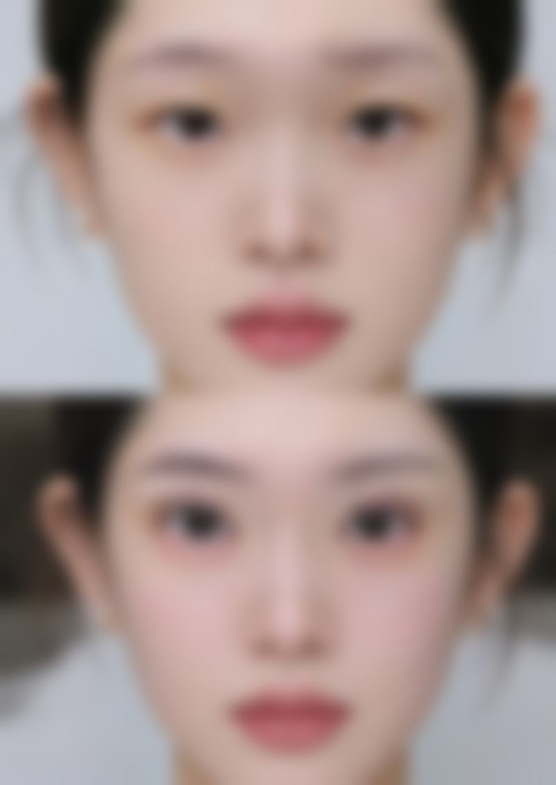 埋线双眼皮宽度多少合适？一般5 - 8mm较适宜，具体还得结合眼部特征与审美需求定！ 