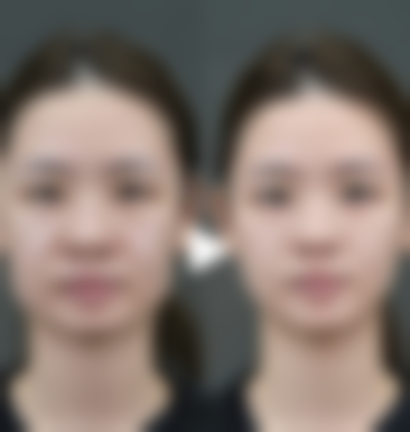 五、株洲华美整形美容黄明光医生技术怎么样?