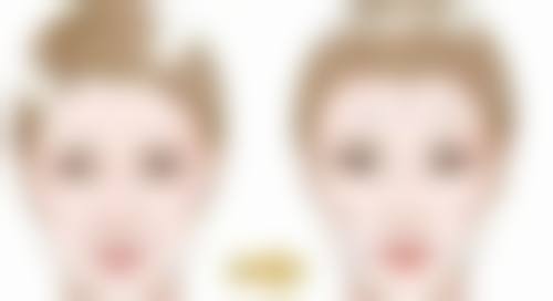 激光治疗改善烫伤疤痕