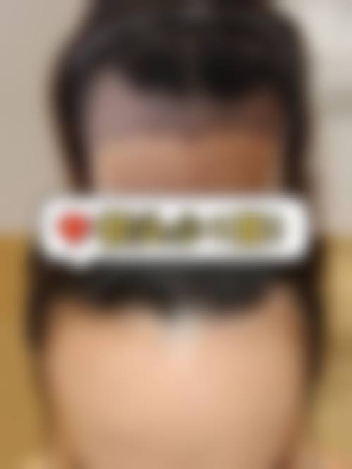 六、阜阳科发堂曙光植发医院口碑如何？