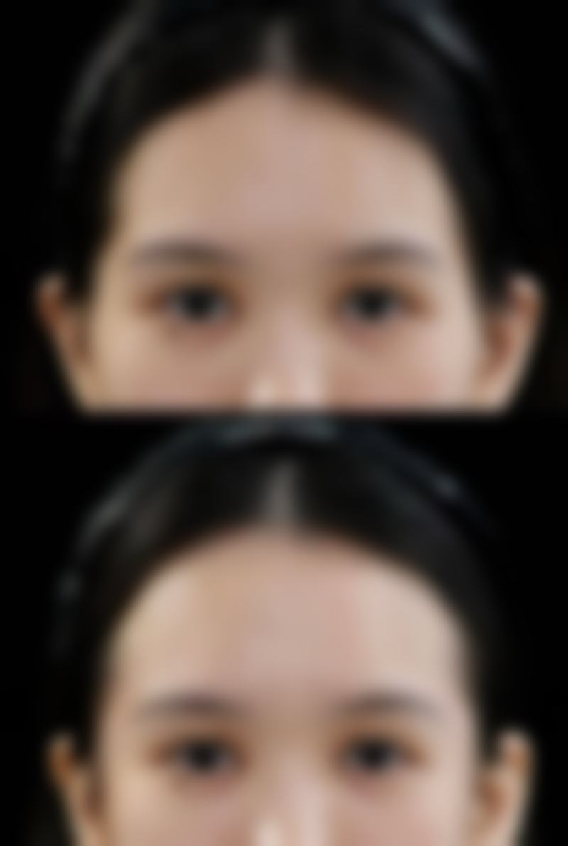 生长因子被明令禁止用于丰太阳穴