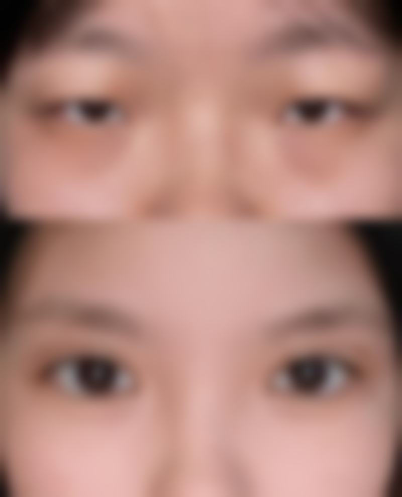 隆鼻碰到了会怎么样？碰撞力度、时间和隆鼻方式不同，影响各异，严重或致移位骨折！ 