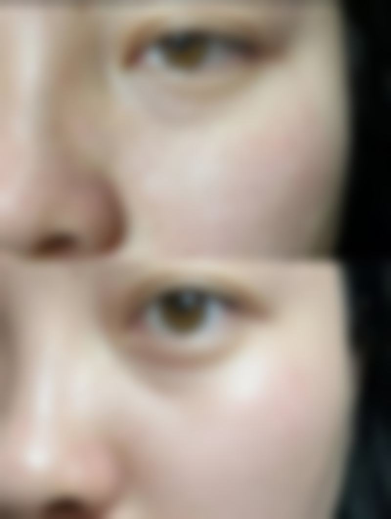 生长因子可以丰太阳穴吗？不可以！其用于丰太阳穴风险高，还被明令禁止，千万别用！ 