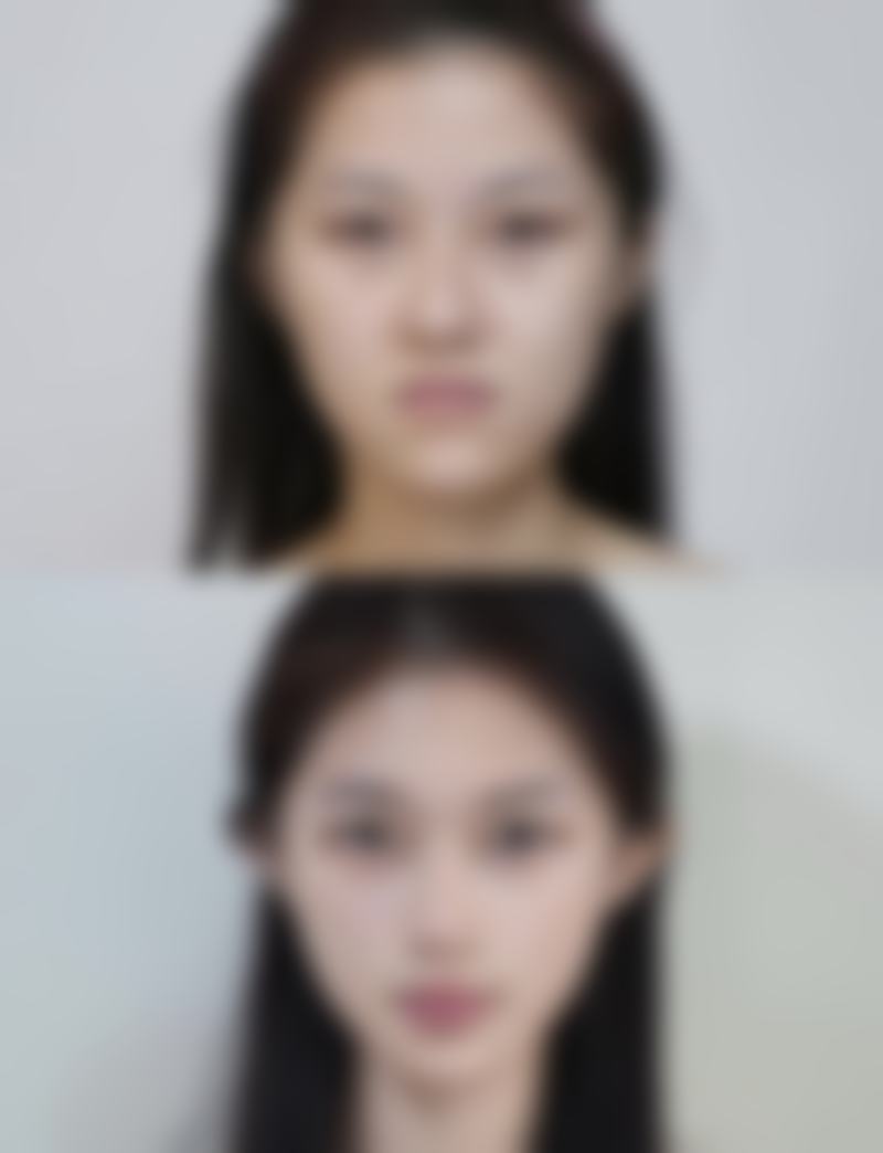 电波拉皮可以去眼袋吗？效果受多种因素影响，需结合个体情况评估选择合适方法！ 