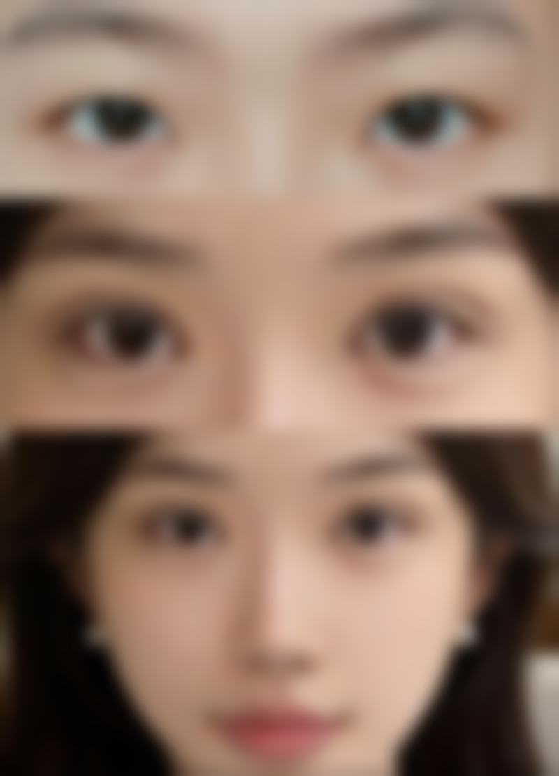 电波拉皮可以去眼袋吗：电波拉皮去眼袋与其他方法的对比