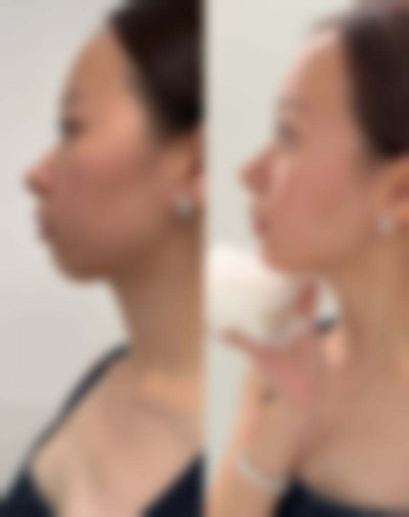 腰部吸脂成效明显吗？留意风险与护理