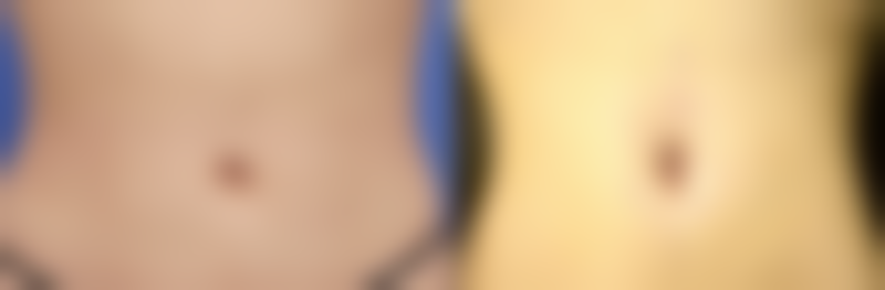 6D双眼皮术后生活习惯的调整要点