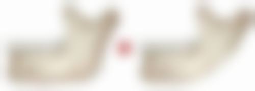 激光疗法改善疤痕凹陷