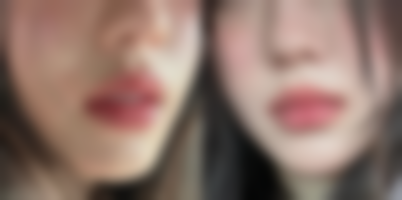 疤痕切开重新缝合的修复成效