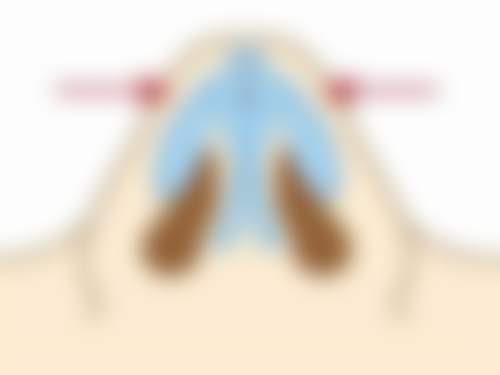 手术疤痕的形成与特点