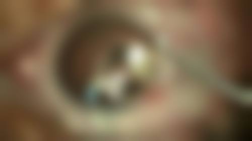 脸上20年凹陷疤痕怎样去掉？正规评估选个体化方案