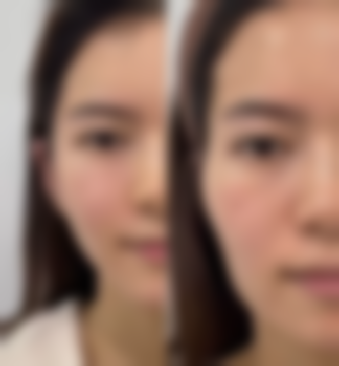 祛眼袋前后的注意事项