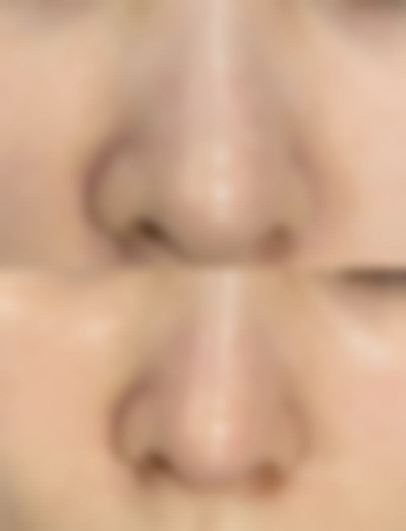 如何预防烫伤后疤痕增生？从创面护理、抗疤药物到康复锻炼，多管齐下有妙招！ 