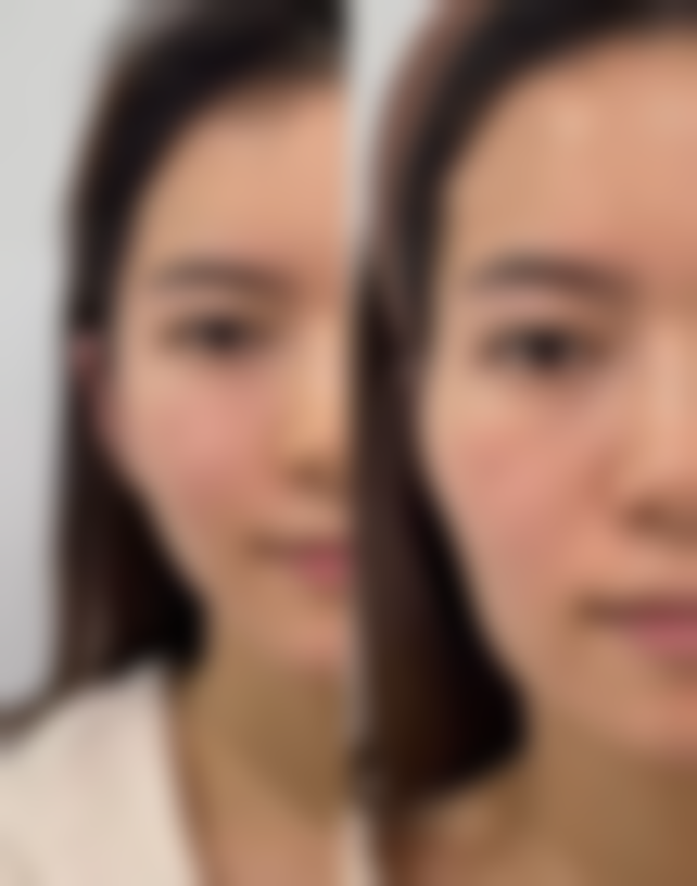 如何预防烫伤后疤痕增生?修复锻炼特别重要