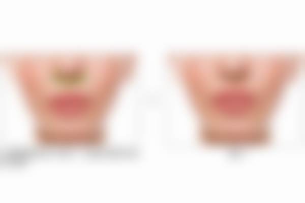 塑妍真·真好1mL聚己内酯除皱【新客首单】购买须知