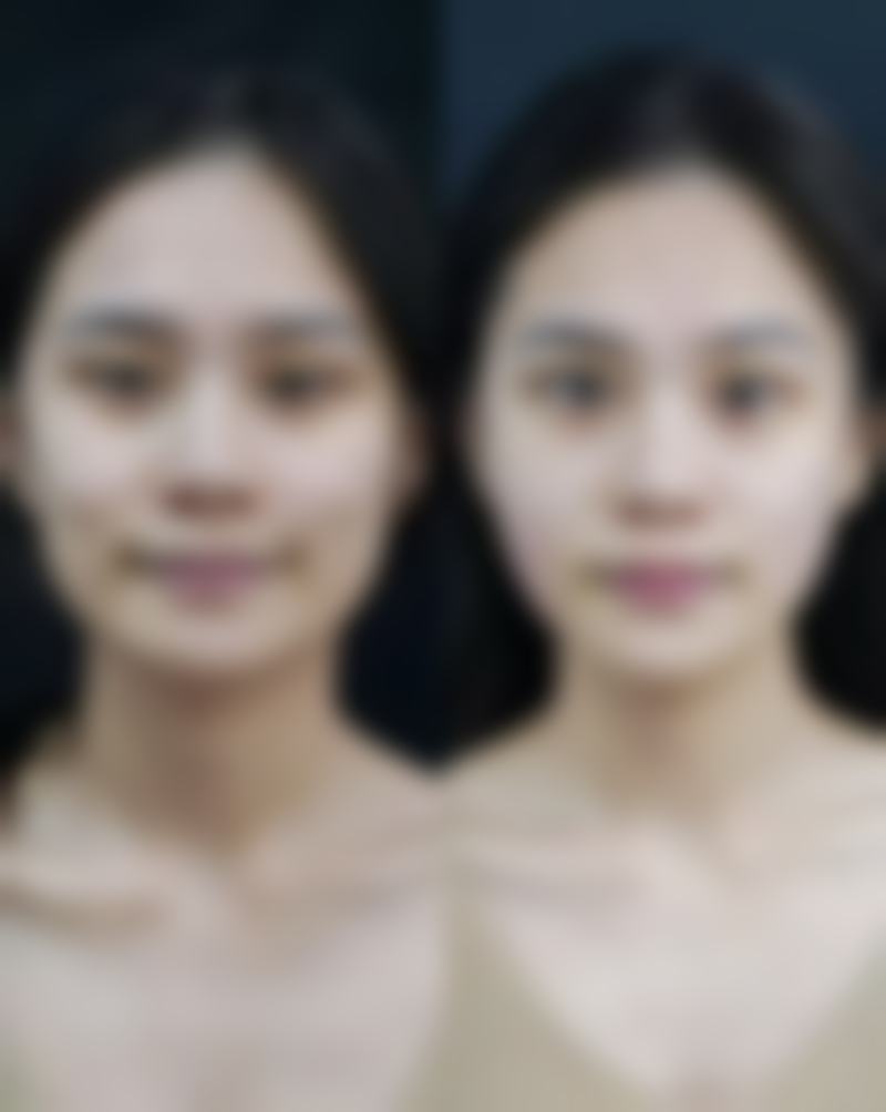 阴道缩小手术有危害吗？积极应对降低风险