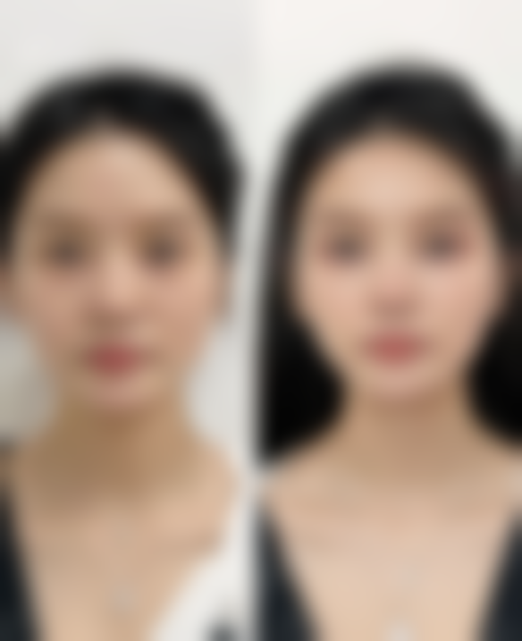 轻度干眼症：或可自行修复