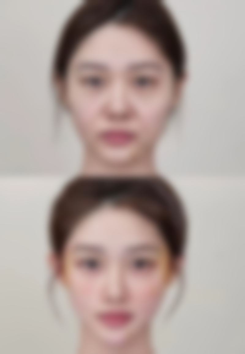 大腿吸脂之后多久可以同房？不同医生观点不一，一般1 - 2个月，也有建议2周或术后两三天！ 