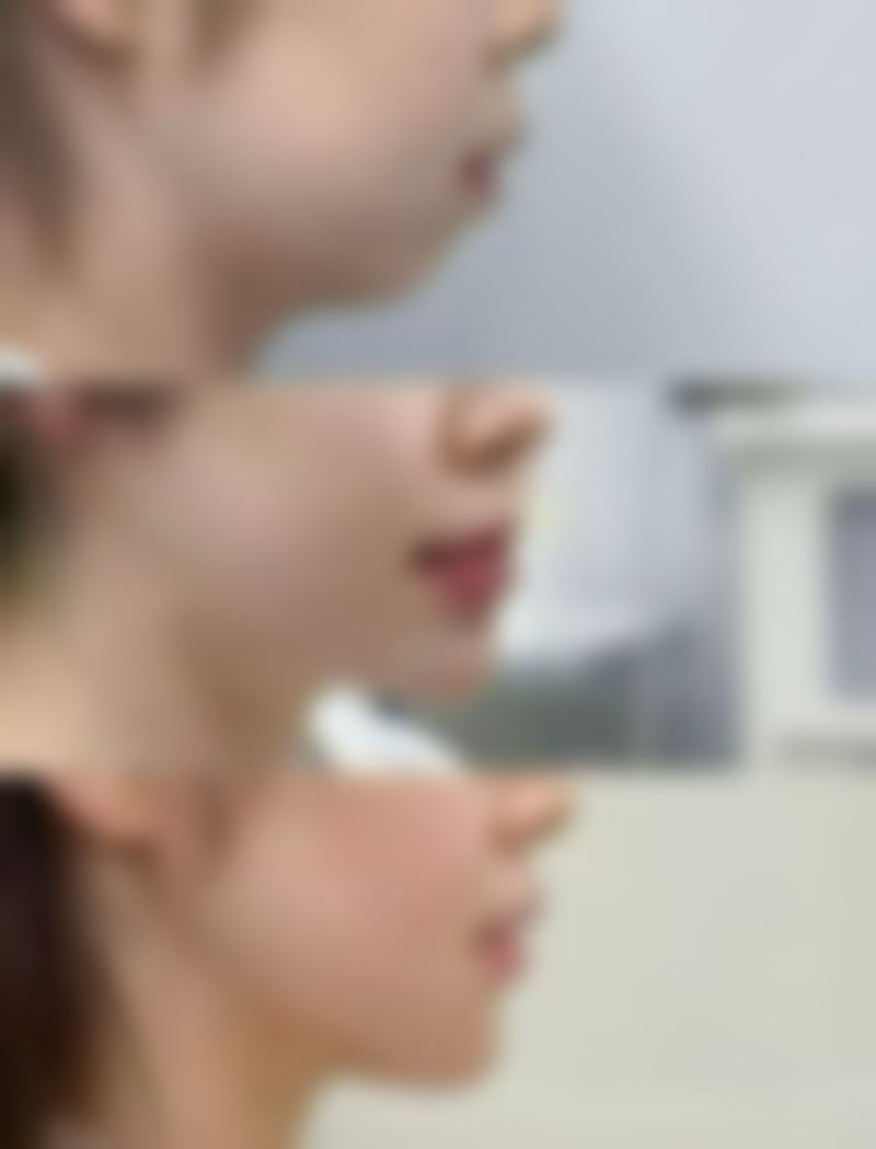 大腿吸脂之后多久可以同房？影响修复时间的因素