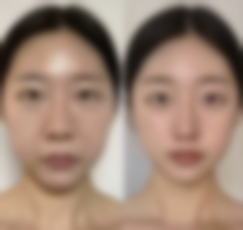 大腿吸脂之后多久可以同房？同房时的注意事项