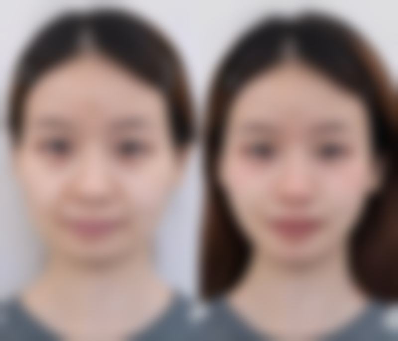 疤痕体质可以洗眉毛吗？需谨慎，虽激光洗眉创伤小，但仍有增生风险，要先咨询医生！ 