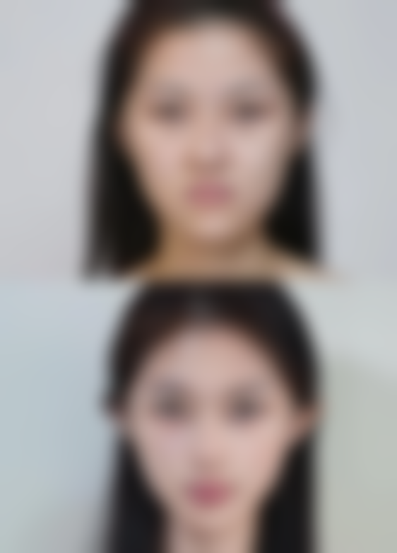 假体的隆胸是永久的吗？效果受多因素影响，一般维持10至20年，保养好可更持久！ 