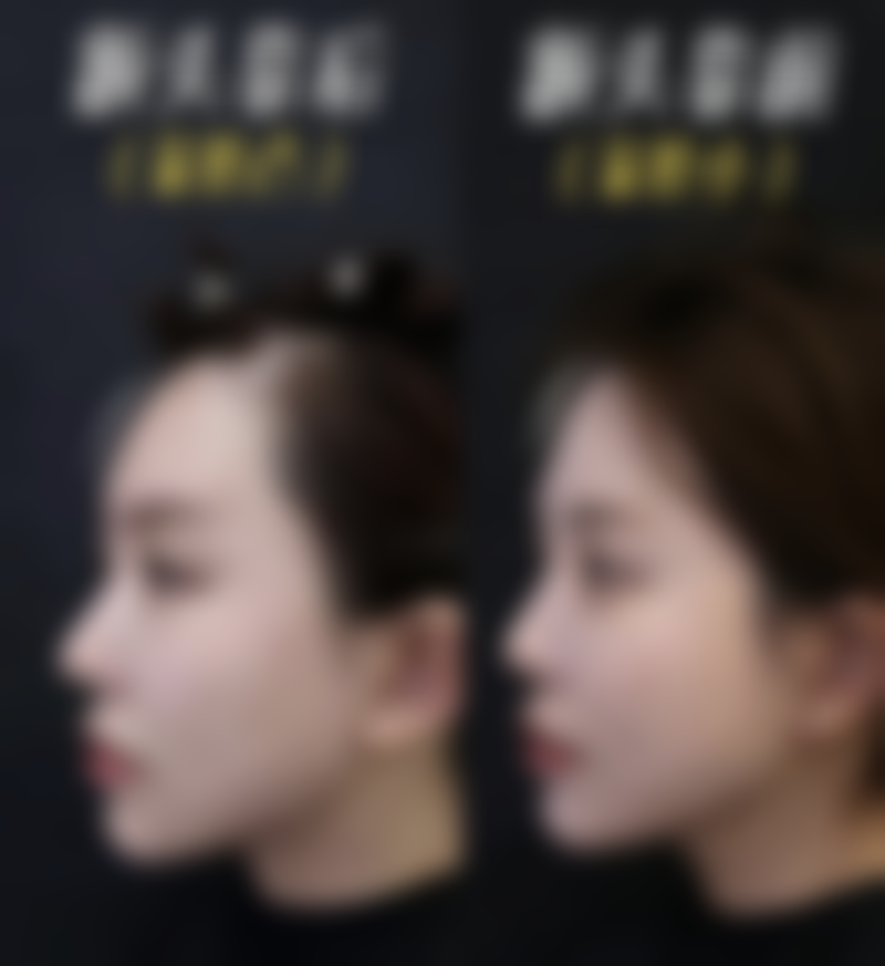 不同年龄段隆胸的特点和考虑因素