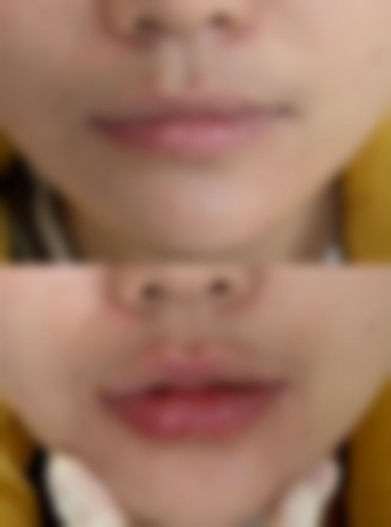 身体状况对隆胸年龄的影响