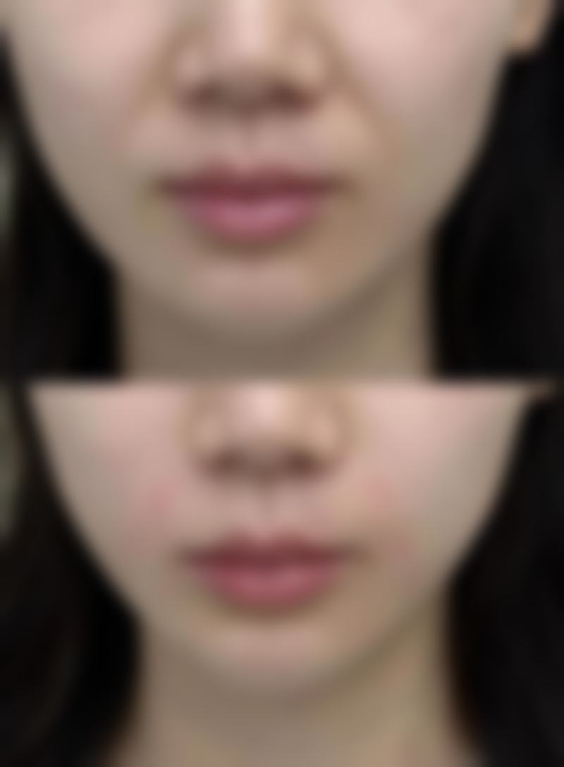 做了阴道修复多久能同房？这取决于伤口愈合、个体差异等，一般4 - 8周，需遵医嘱！ 