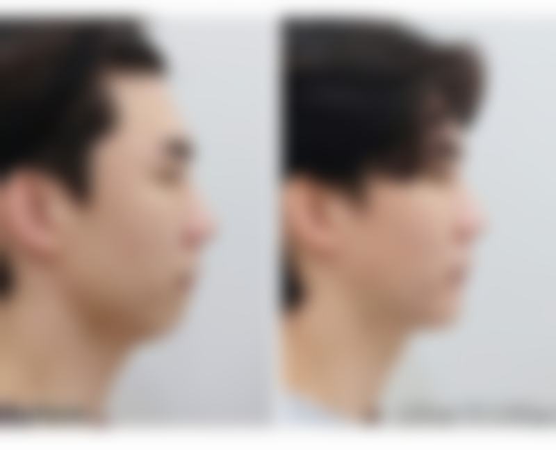 多数情况可自然修复