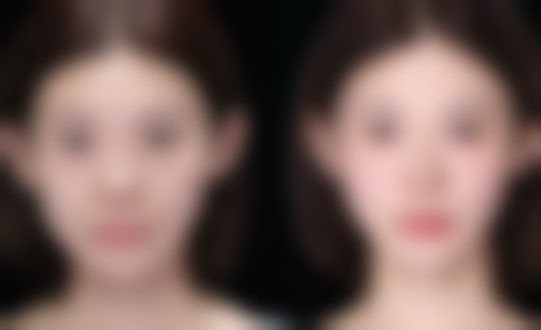 重度下垂或需二次手术