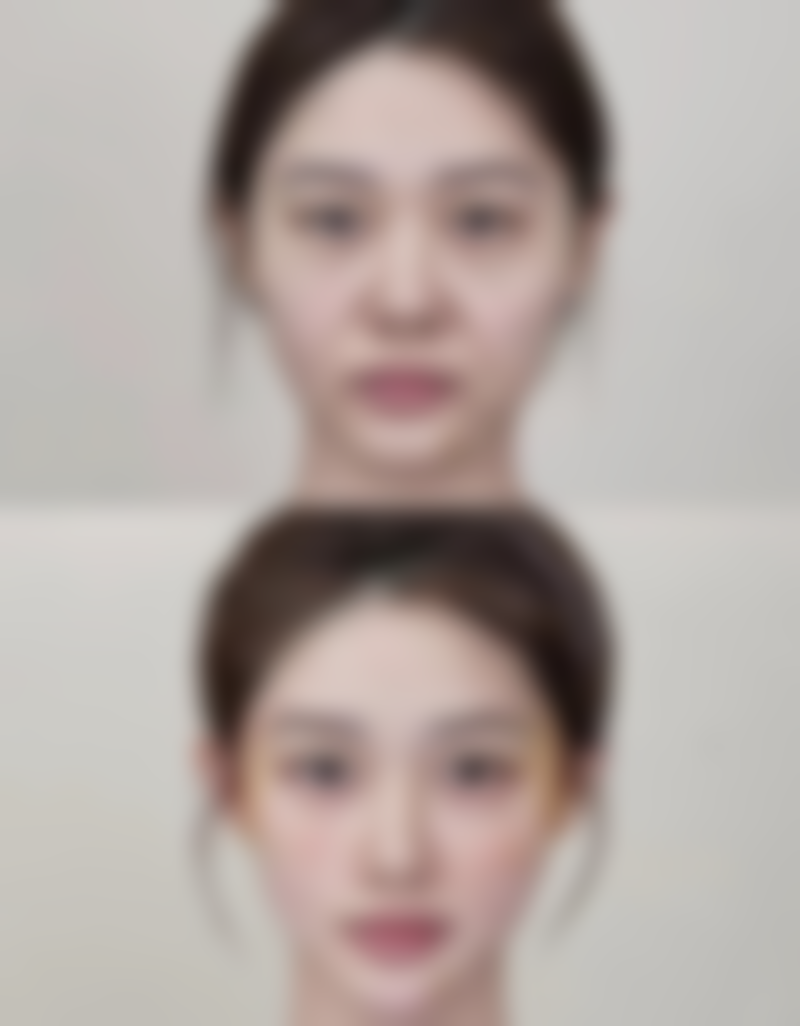 什么人不适合割双眼皮手术？像患基础病、处特殊时期、特殊体质等人群要谨慎！ 