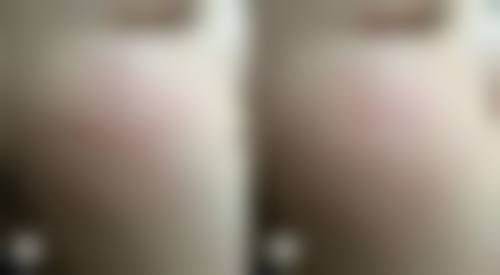 巴克祛疤膏的作用原理和功效