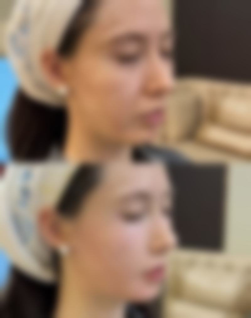 营养状况左右疤痕修复速度