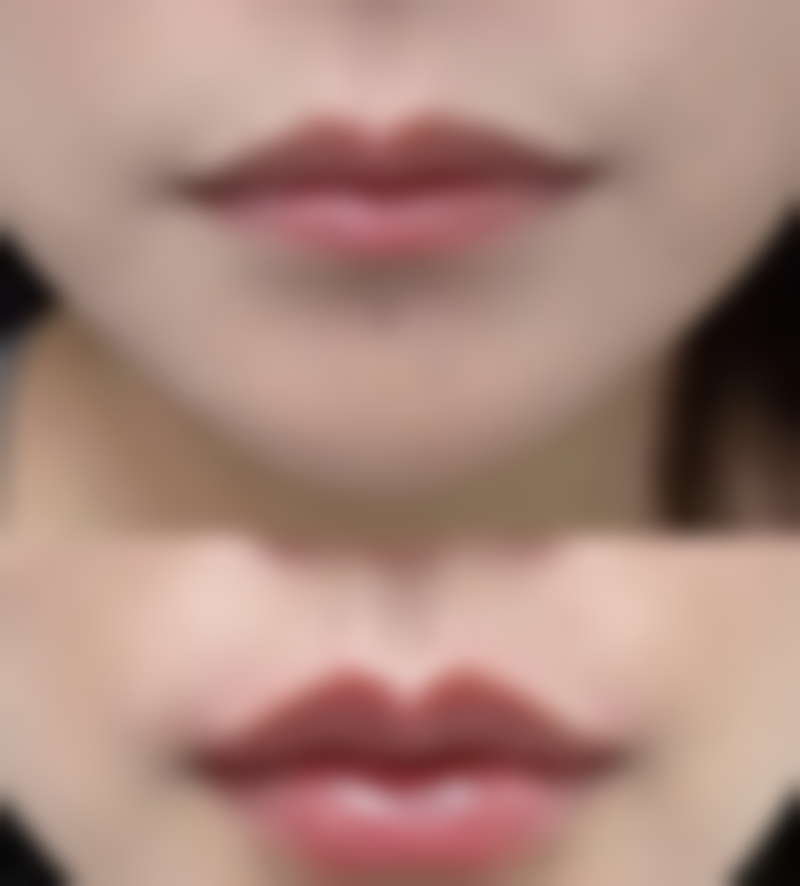 全切双眼皮十年后上眼皮下垂的应对策略