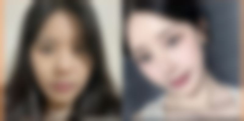 泡眼做双眼皮的注意要点