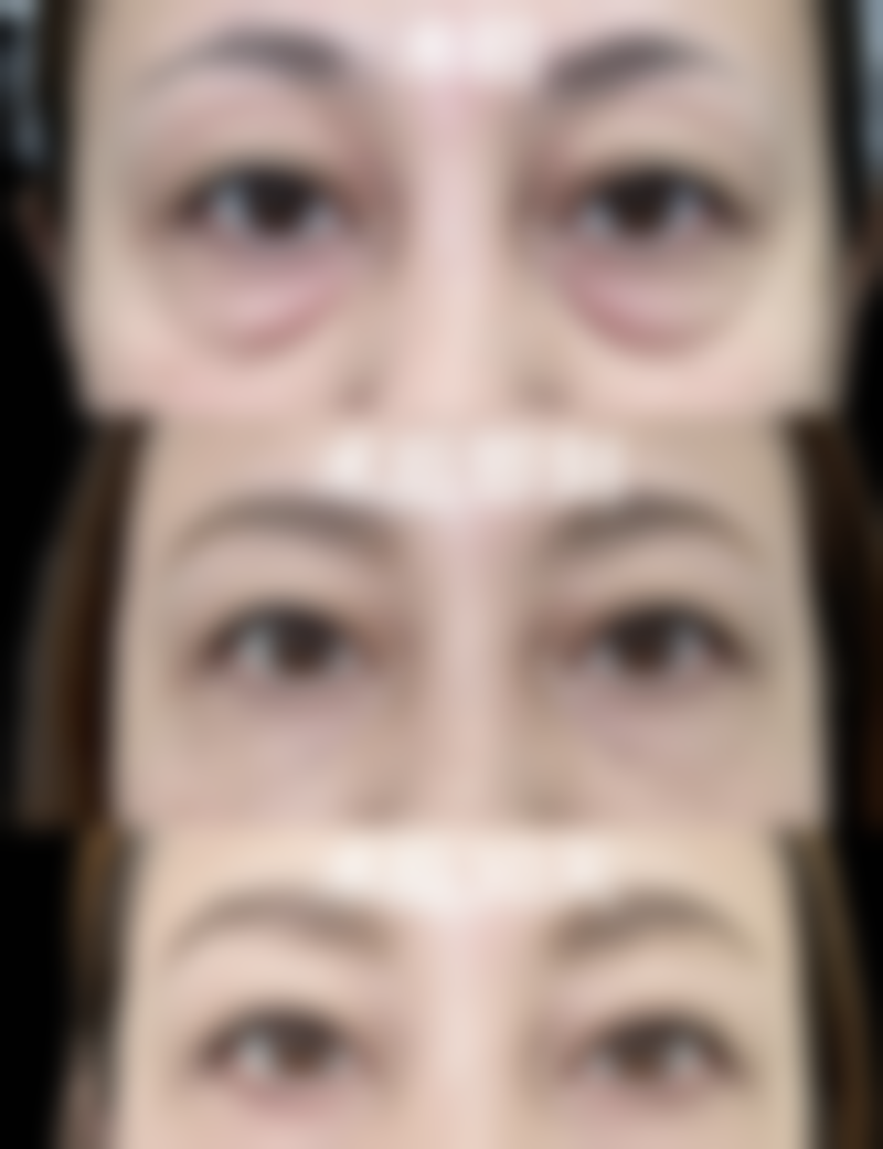 泡眼做双眼皮的方式选择