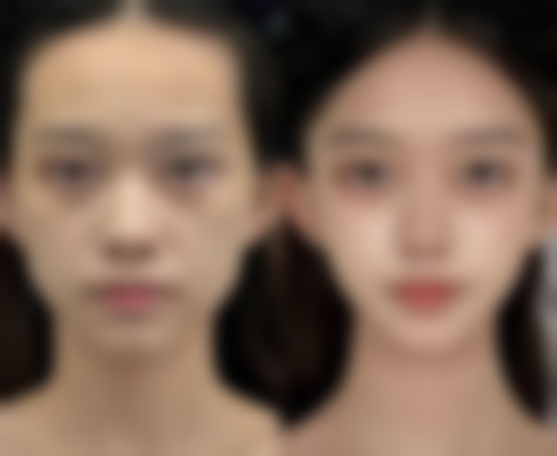 打瘦脸针前的注意事项