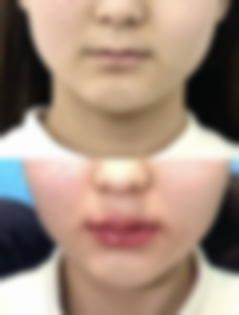 吸脂减肚子脂肪的适用情况