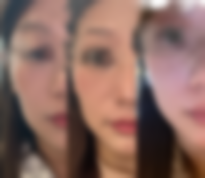 超体隆鼻和膨体的价格对比