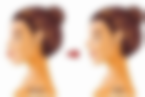 祛眼袋哪种手术好？无痕与外切各有优劣，需结合年龄、眼袋程度等个体情况选！ 