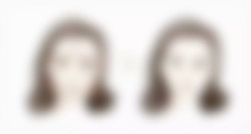 杭州悦可医疗美容诊所灵韵双眼皮术的术前准备