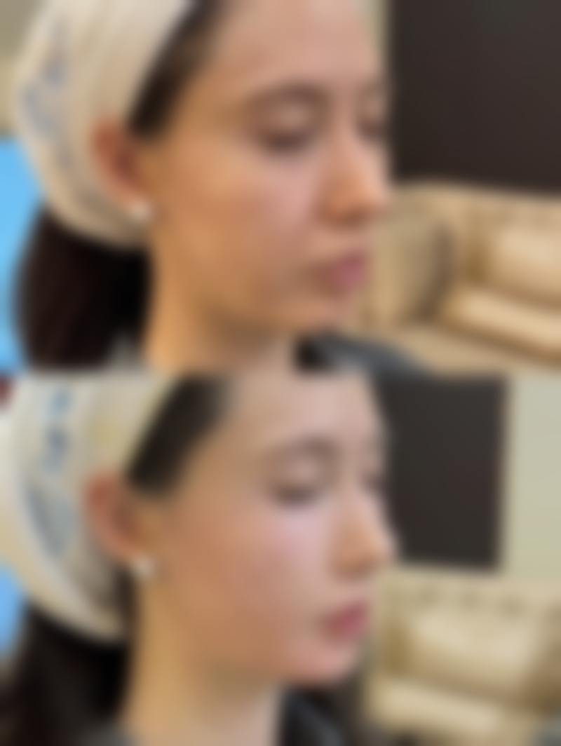 割双眼皮多久可以备孕？多数建议3个月后，具体还需结合个人身体状况及医生建议来定！ 