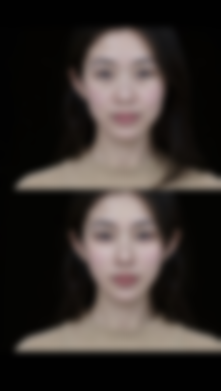 全切双眼皮什么时候冰敷？术后72小时内可适当冰敷，防淤血促消肿，注意别直接接触眼部！ 