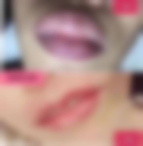 医学美容手段，快速消除眼袋