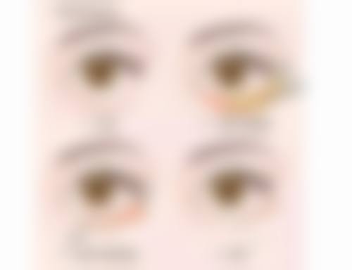 怎样快速除眼袋的小窍门？日常护理与医学美容双管齐下，助您轻松告别眼袋困扰！ 