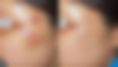 去眼袋手术存在的风险