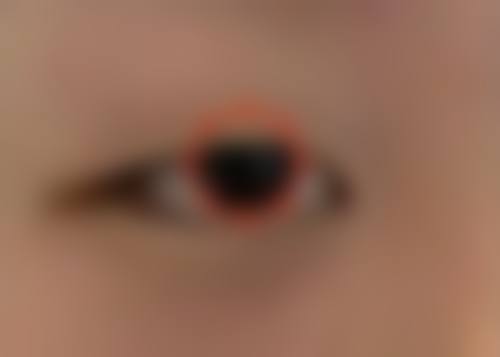 物理治疗改善点痣后疤痕增生