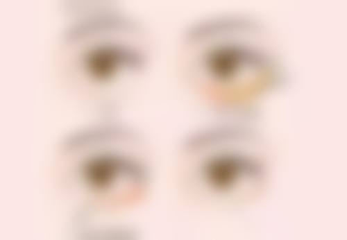 抽脂技术对全身抽脂手术时间的影响